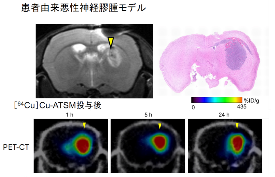 横浜市立大学】悪性脳腫瘍に対する“低酸素領域標的型”局所放射線治療の