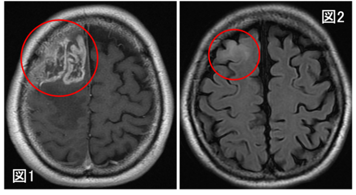 裁断済み　脳腫瘍 膠芽腫の画像起源の解明～いつから腫瘍は存在していたのか？～（北里