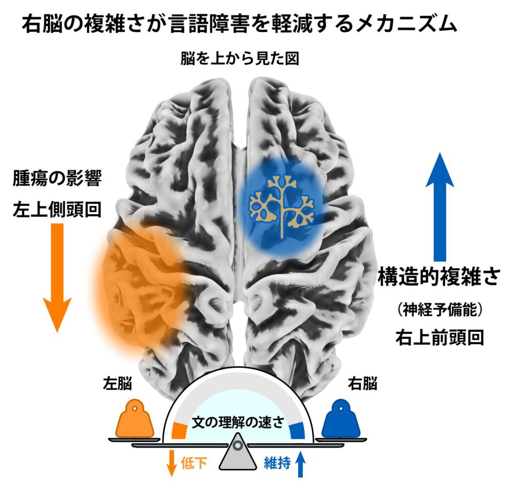 昭和医科大学】左脳の脳腫瘍による言語障害の個人差を解明 ― 右半球の