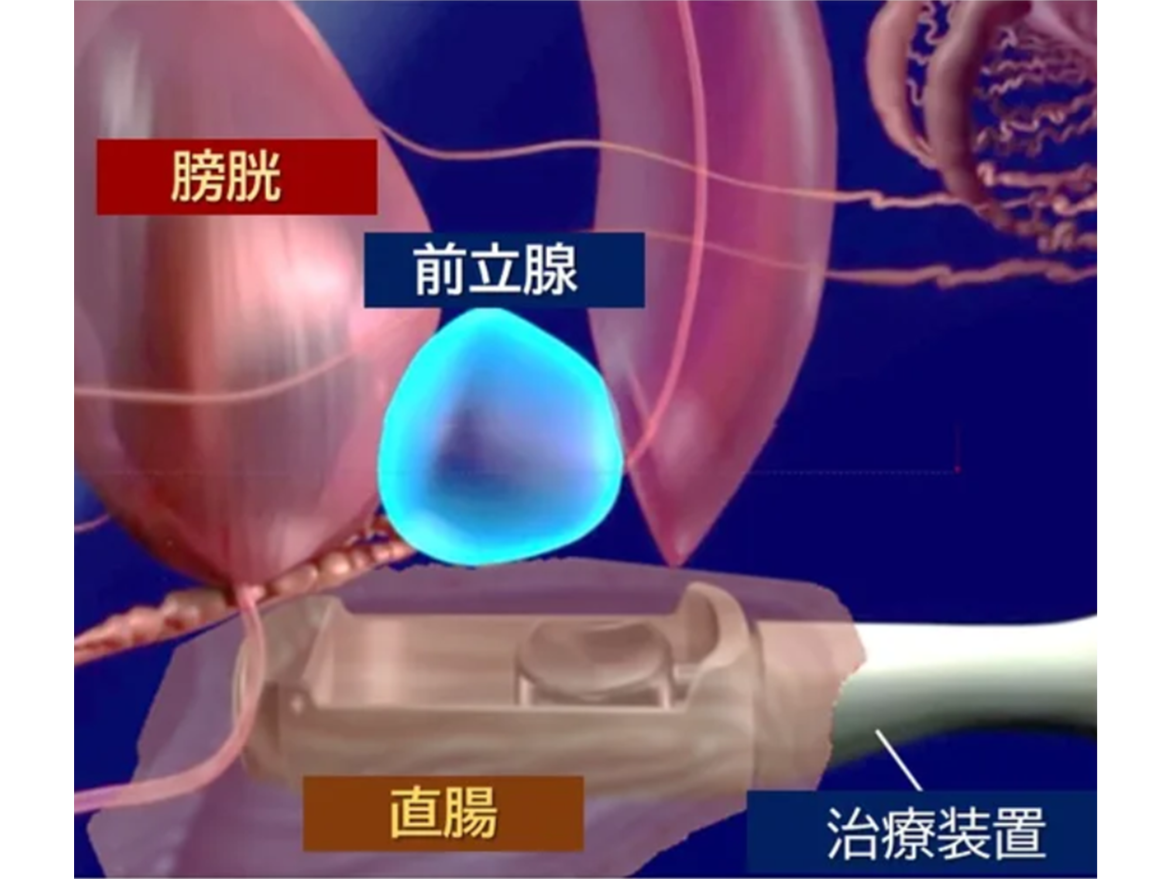 西日本初！先進医療 HIFU（ハイフ）を用いた前立腺がん局所療法を香大病院で開始